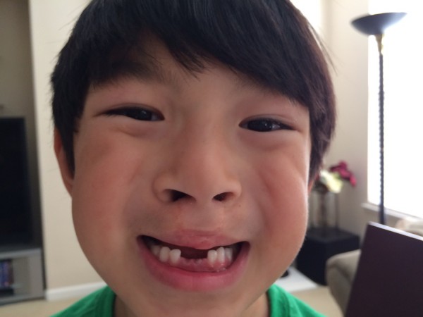 2015.6.28 - Missing Teeth